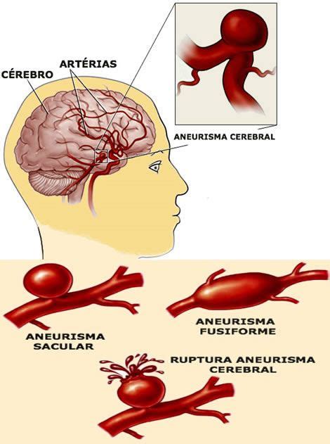 Ano ang sintomas ng aneurysm